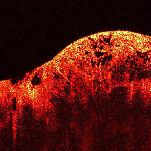 optical coherence tomography of muscle tumor